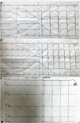 Case report: The presence of third-degree atrioventricular block caused by pulmonary embolism masquerading as acute ST-segment elevation myocardial infarction